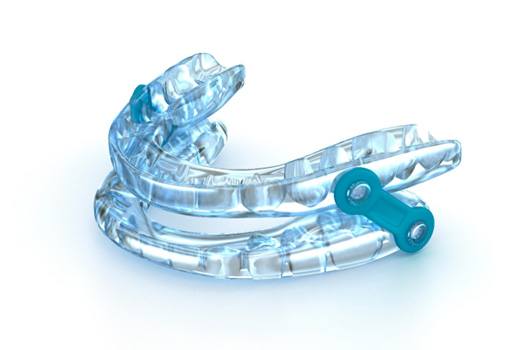 Translucent blue oral appliance for sleep apnea with white background