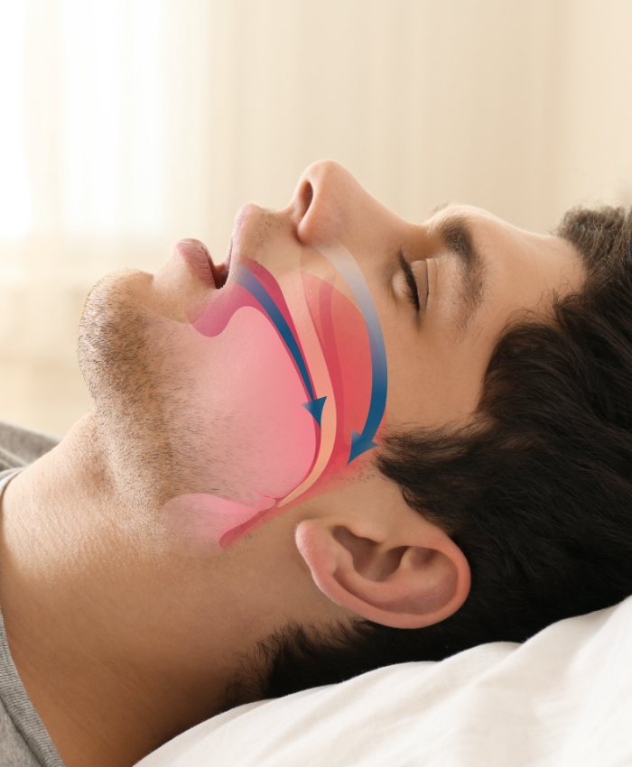 Sleeping man with animated airway over his profile