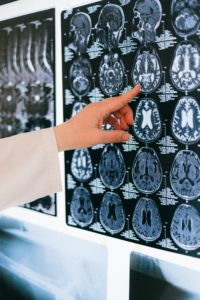 Hand pointing to brain scan