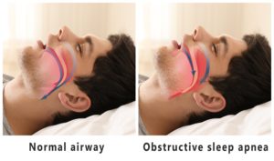 Airway comparison with sleep apnea