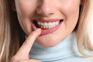 Woman pulling down lip showing signs of gum disease
